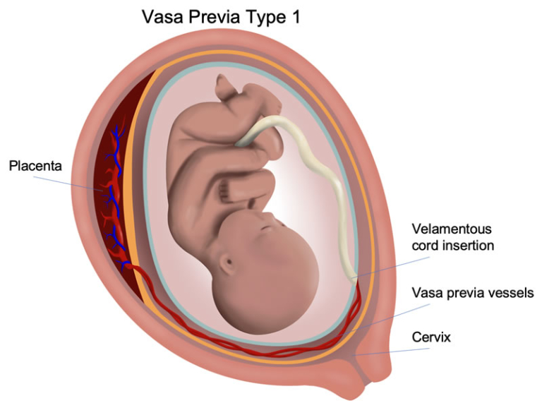 Vasa Previa Los Angeles Fetal Surgery