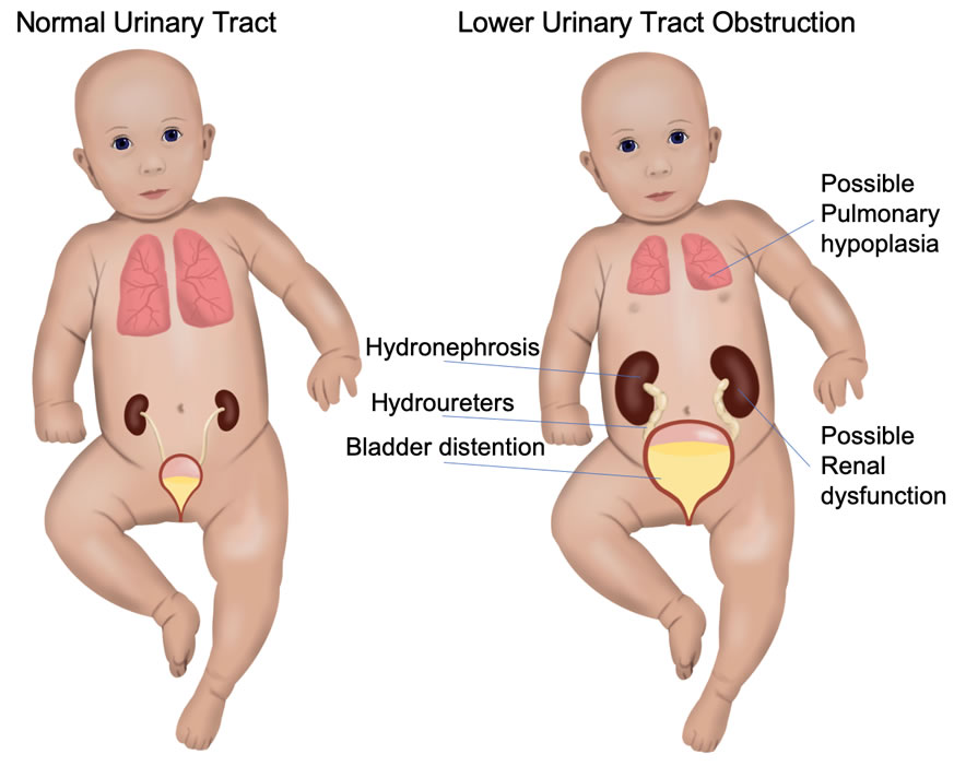 Lower urinary tract obstruction (LUTO)
