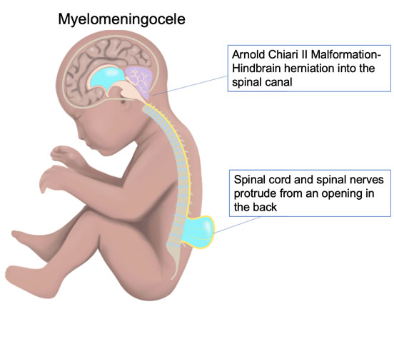 Open Spina Bifida Myelomeningocele Los Angeles Fetal Surgery