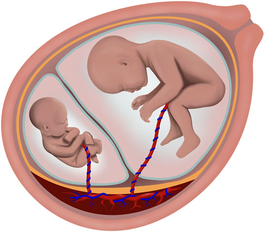 Twins measuring small for gestational sale age